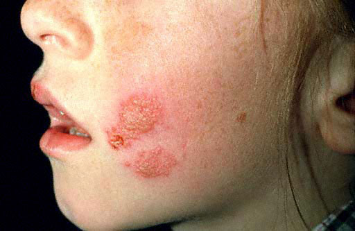 Skin Lesions: 45 Causes with Pictures, Types, & Treatments