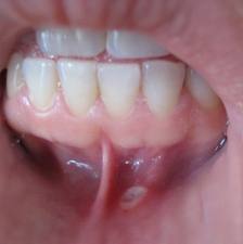 oral herpes (cold sore) vs apthous ulcer (canker sore ...